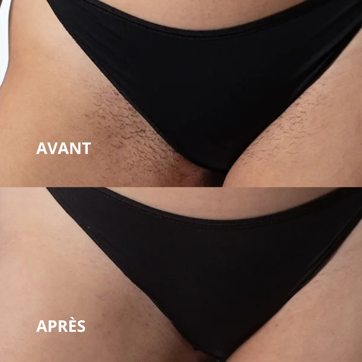 Épilation laser du maillot, avant et après