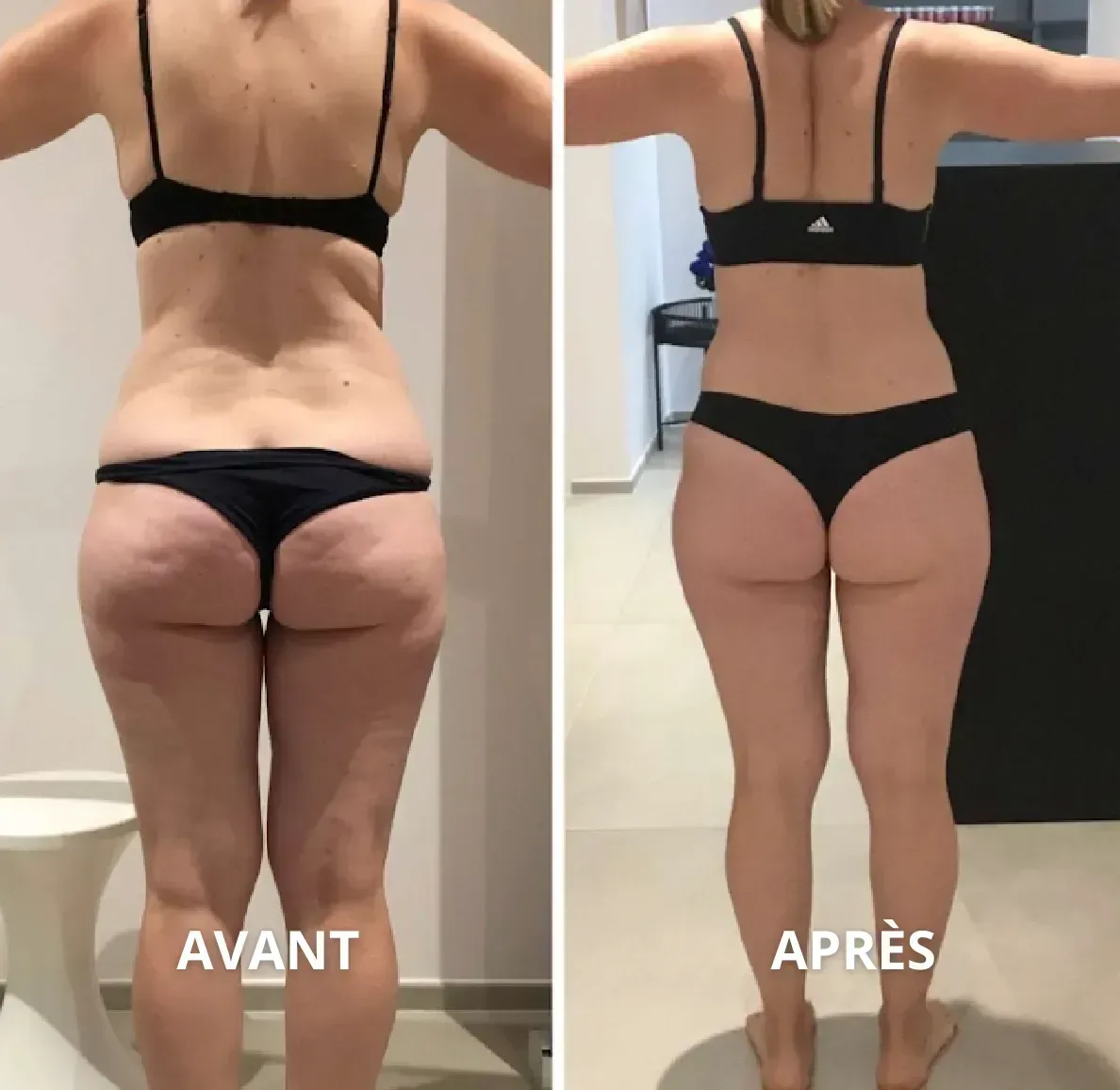 Résultat minceur chez BodySlimTec, avant et après, fesses et cuisses