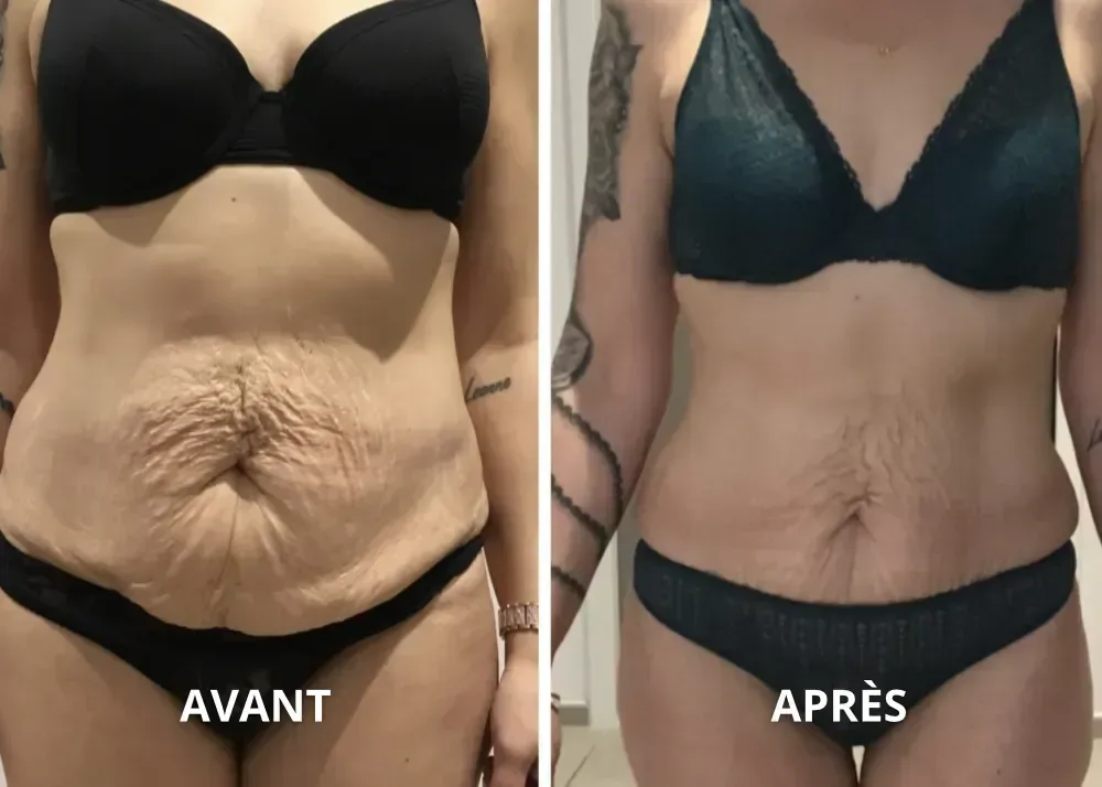 Résultat minceur chez BodySlimTec, avant et après, ventre