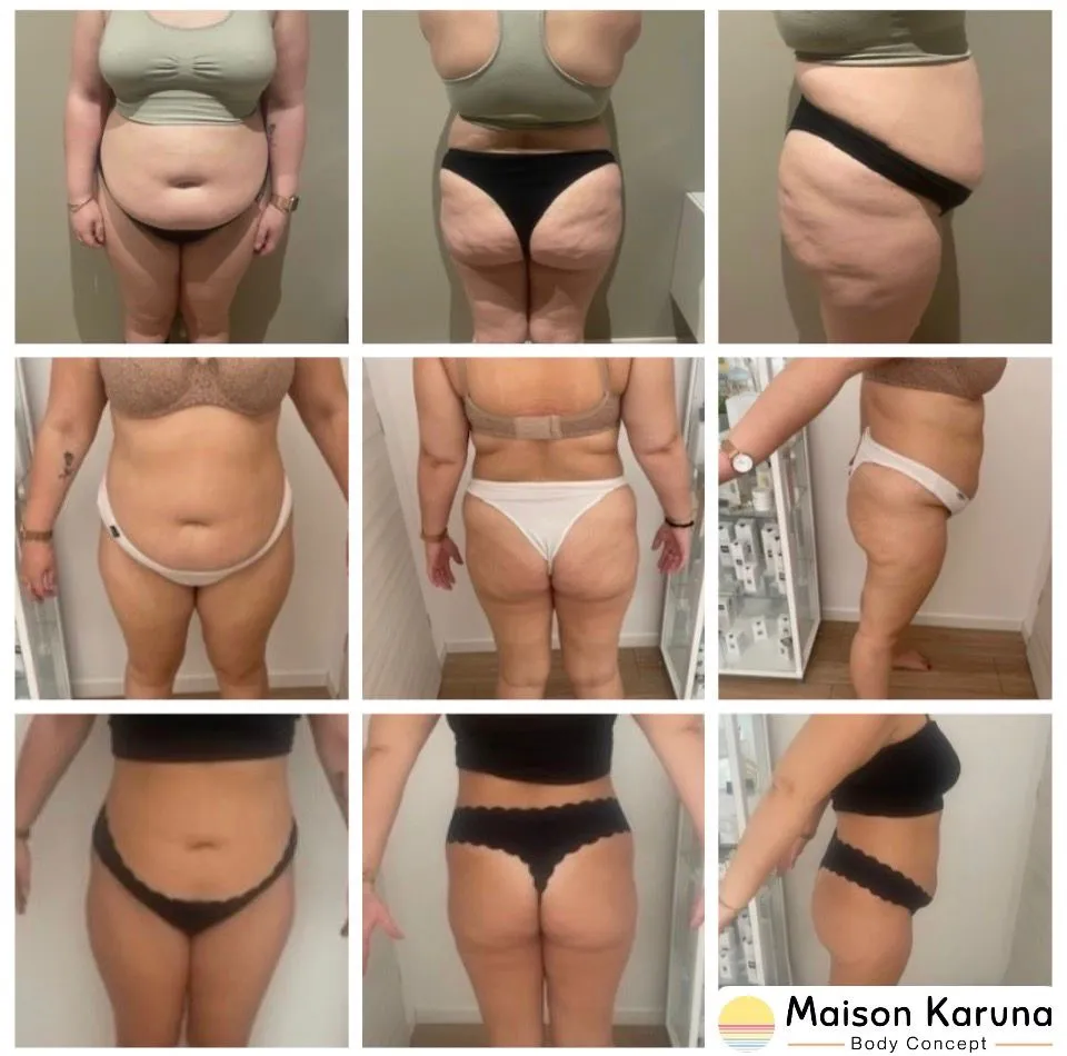 Résultats clients cryolipolyse
