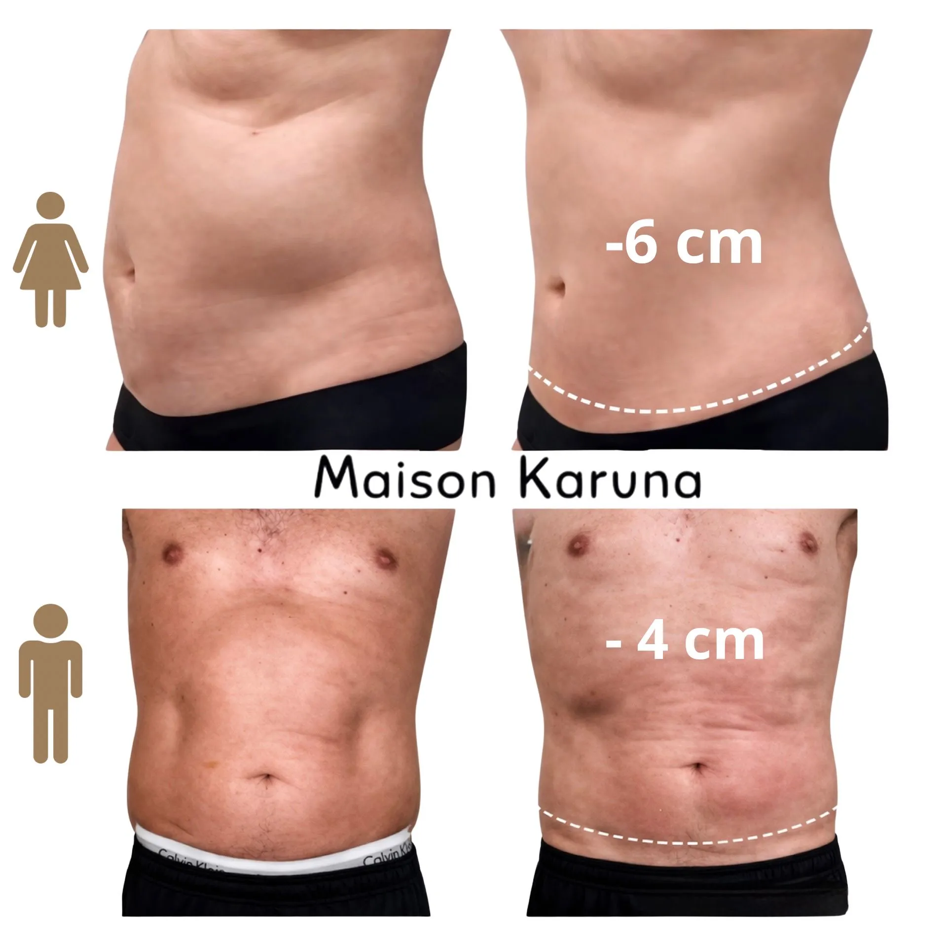 Résultats clients cryolipolyse - homme
